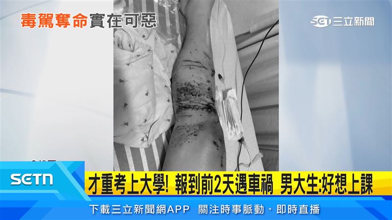 男大生遭撞重傷,報到前兩天仍躺病床,右大腿開放性骨折,面部、手腕也被撞斷