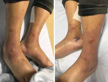 路易斯安那州在食肉細菌感染病例驚人激增後進入高度警戒狀態,今年每例病例都來自開放性傷口接觸海水,且患者均有潛在健康問題。。(圖/翻攝自X平台 @MarioNawfal)