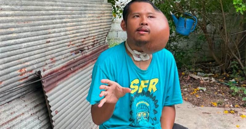 泰國一名31歲男子近日因左臉出現巨大腫塊引發關注,外界質疑照片疑似經過後製或AI生成。(圖/翻攝自臉書,Poramet Misomphop)