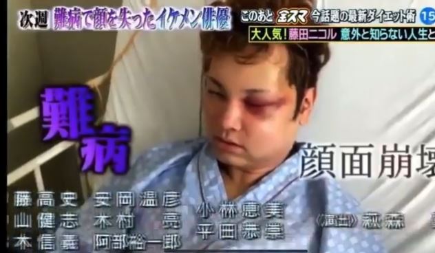 間瀨翔太在2019年突發腦出血,就醫後竟被診斷出罹患機率僅10萬分之一的罕見疾病「腦動靜脈畸形」。(圖/翻攝自IG)