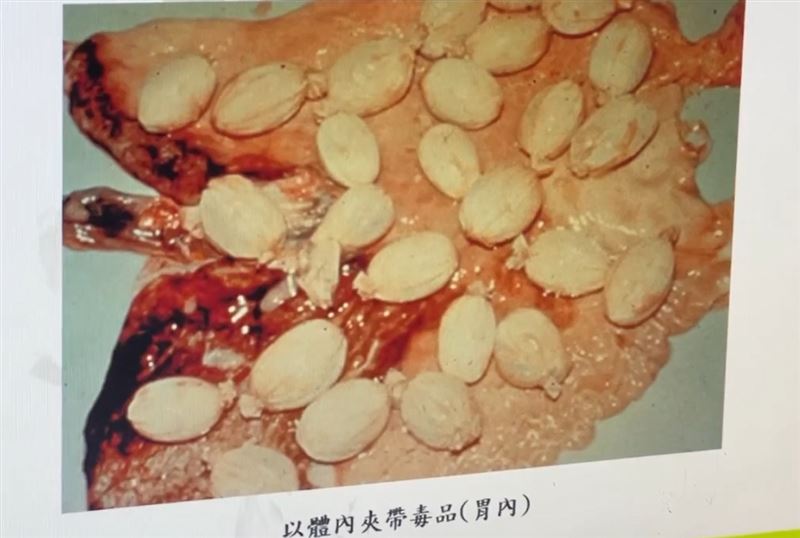運毒者用保險套包裹毒球吞進體內，不料其中一顆毒球在胃部破裂，當場毒發身亡。(圖／法醫高大成提供)