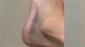踩到刺傷口竟爛半年？6旬婦險截肢原因曝