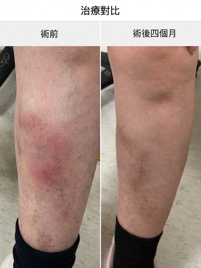 靜脈曲張合併急性血栓性靜脈炎,術前(左)、術後(右)比較。(圖/長庚醫院提供)
