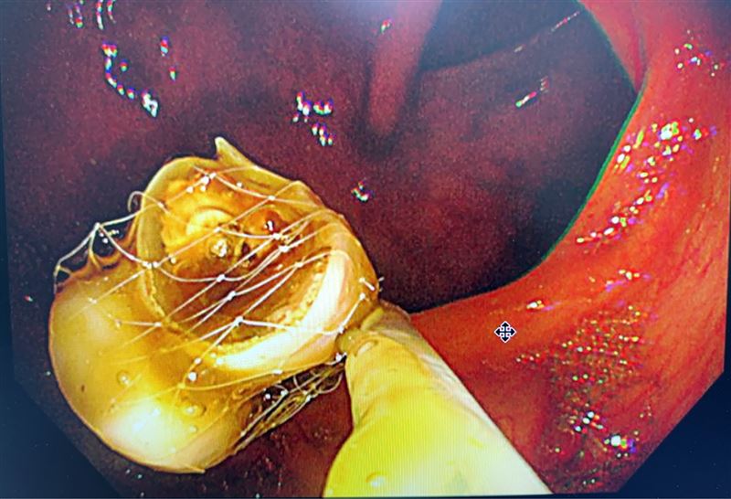 醫師使用大腸內視鏡加網套,繞過120公分大腸後,順利取出假牙。(圖/澄清醫院提供)