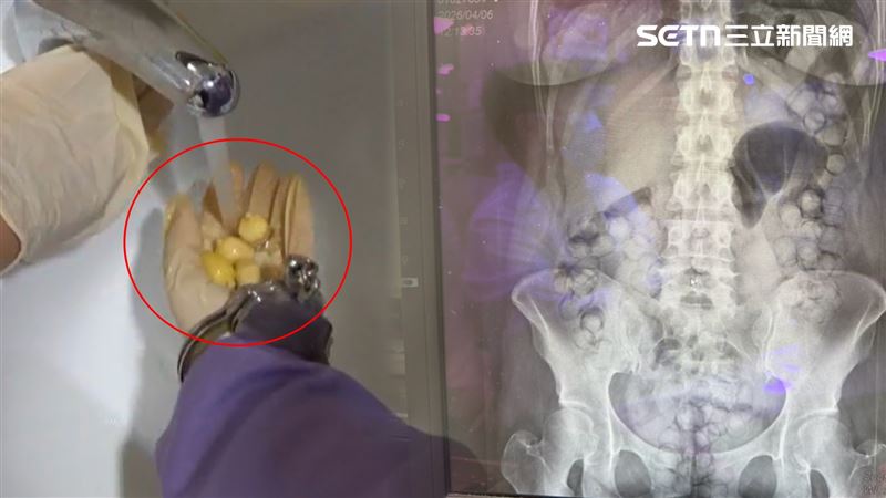 經X光一照,泰籍女子腹部密密麻麻橢圓形異物,她一人吞了72顆海洛因膠囊,市價360萬元。(圖/翻攝畫面)
