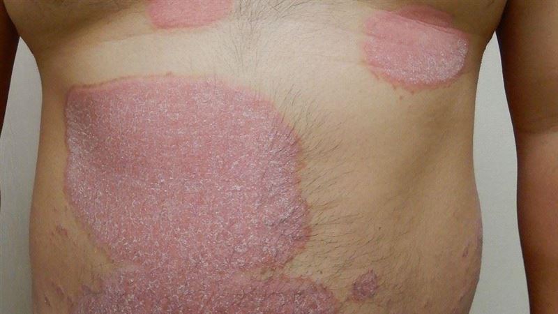 50歲男身上驚見「麥田圈」 醫揭關鍵警訊
