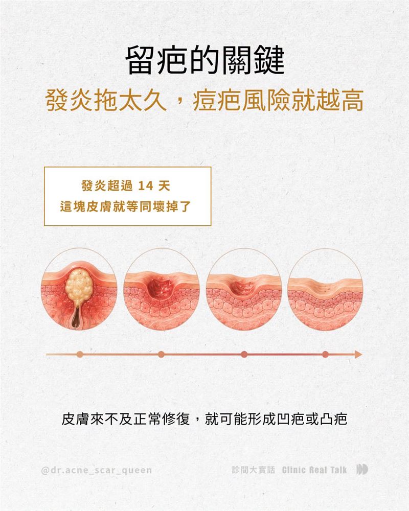 痘痘持續發炎的時間越長,越容易留下痘疤。(圖/翻攝自莊盈彥臉書)