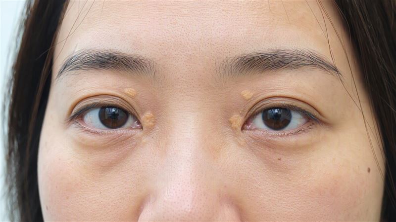 高血脂沒症狀！冒4黃色瘤=血管油滿到溢出