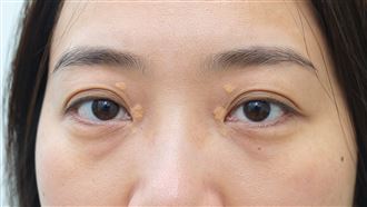 高血脂沒症狀！冒4黃色瘤=血管油滿到溢出