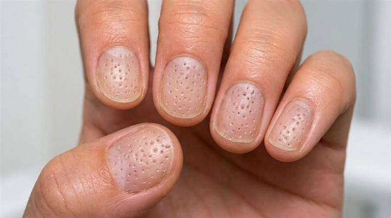指甲冒針戳小凹洞！醫：恐免疫系統出狀況
