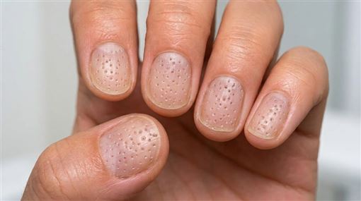 指甲冒針戳小凹洞！醫：恐免疫系統出狀況