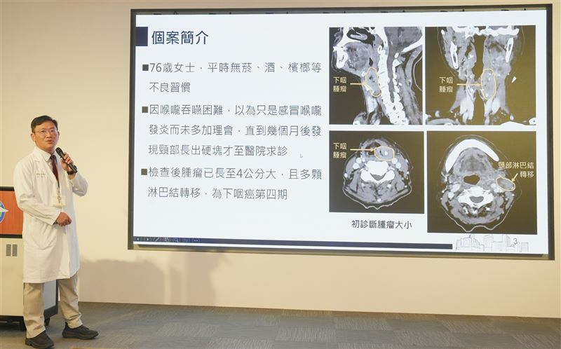 台中76歲婦人沒有不良嗜好，喉嚨卡卡、出現腫塊後就醫，竟確診下咽癌第四期。（圖／中國附醫提供）