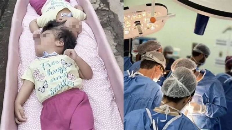 2歲連體嬰5度手術　數分鐘內接連心臟驟停