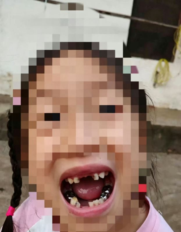 中國5歲女童被機器人踢中臉部導致4顆乳牙脫落,如今證實是宇樹科技的機器人。(圖/翻攝自微博)