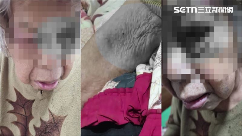 阿嬤全身大大小小傷口及瘀傷