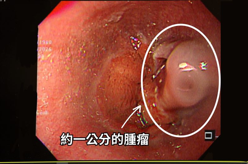 工程師食道上有1公分腫瘤。(圖/中醫大新竹附醫提供)