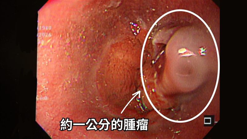 工程師胃食道逆流…吐血　竟已成食道癌