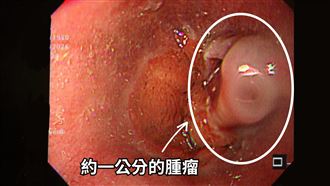 工程師胃食道逆流…吐血　竟已成食道癌