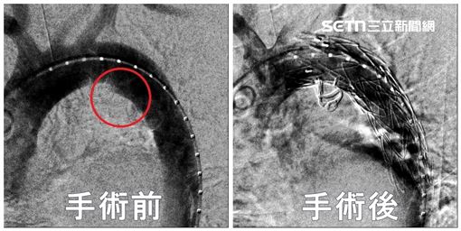 名醫突胸痛從左痛到右　機警揪出體內炸彈