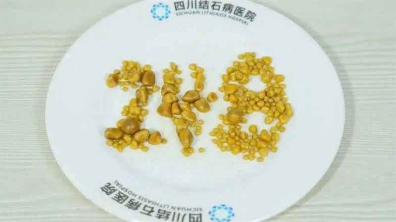 26歲男膽囊塞248顆結石！血脂超標5倍