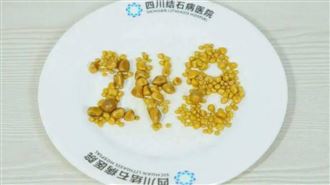 26歲男膽囊塞248顆結石！血脂超標5倍