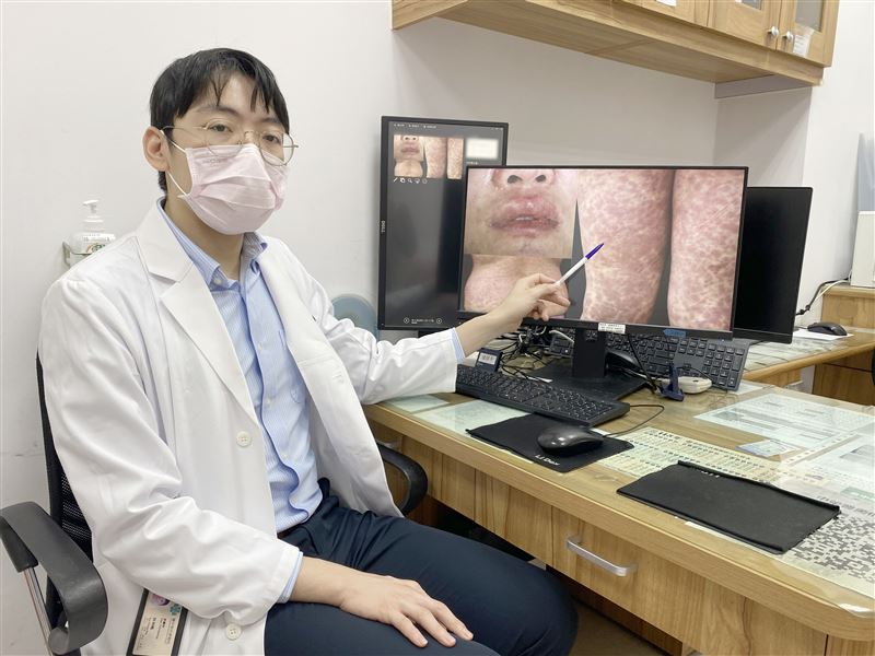 37歲林姓女子，旅行中突然發高燒，紅疹爬滿身，沒想到竟是嚴重藥物過敏。(圖 /台中榮總提供)