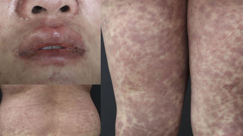 37歲女突發燒紅疹爬滿身　搔癢以為腸病毒