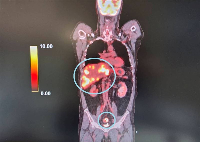 男子肛門出血近1年,看醫生看不好,經正子掃描才知罹患直腸癌第四期,且已多處轉移。(圖/大千綜合醫院提供)
