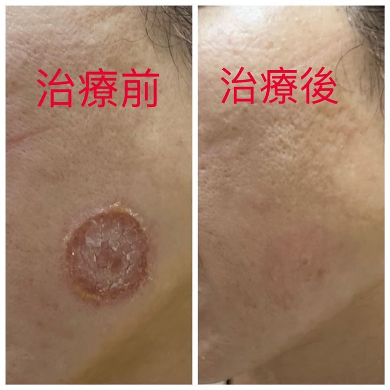 一名20多歲女子因臉部搔癢就醫,短短一週內病灶迅速擴大成50元硬幣大小的結痂斑塊,經皮膚科醫師吳仁欽診斷為遭家中毛小孩傳染皮癬菌。(圖/翻攝自「吳仁欽皮膚科」臉書粉專)