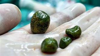 早餐不吃消夜暴食　女膽囊驚見4顆綠松石