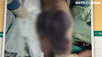 24歲空軍「突說不出話」亡…臀部爬滿瘀青