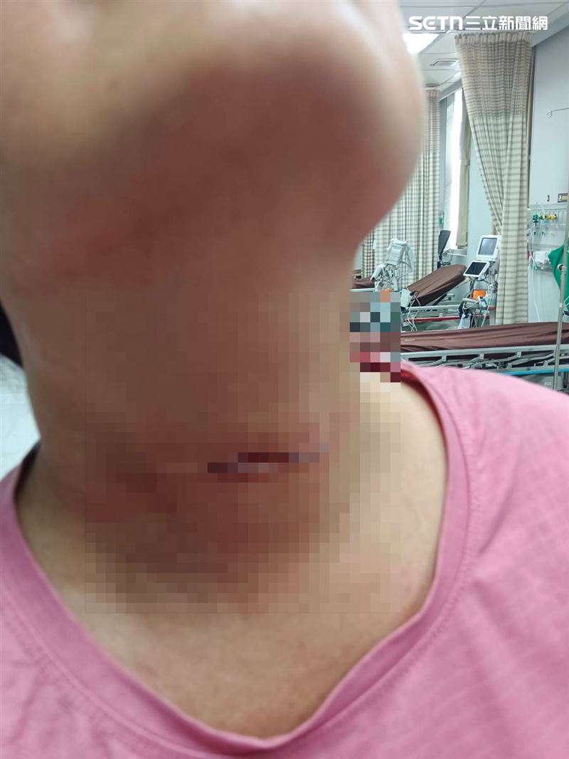 廖小姐脖子上被鐵線割出一道長長的傷痕。(圖/當事人提供)