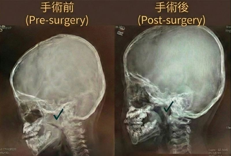 影像打勾處為腺樣體位置，切除手術前灰色區域為腺樣體肥大組織、壓迫鼻腔空間，術後恢復正常空間。（圖／台北慈濟醫院提供）