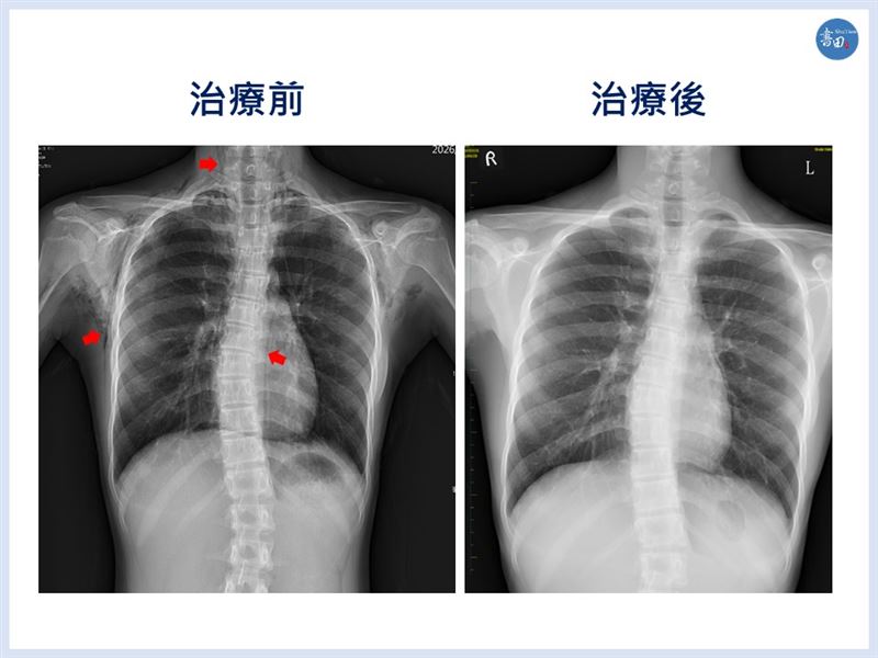 醫師表示,自發性縱膈腔氣腫在臨床上相當少見,約每10萬人中有1-2人發生。圖為患者個案。(圖/書田診所提供)