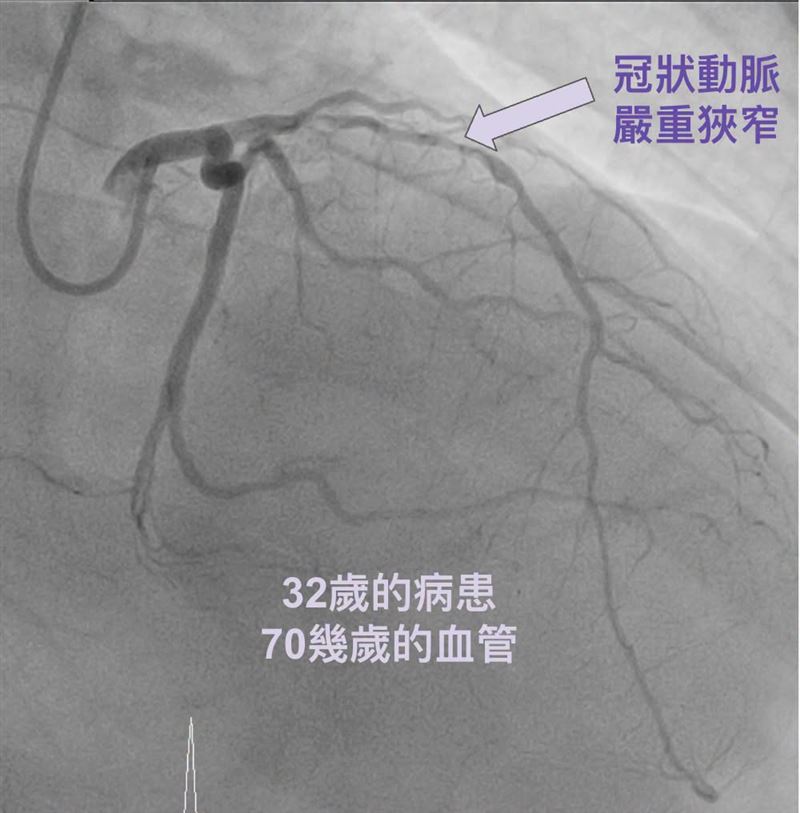 一名32歲年輕人輕忽糖尿病,導致高血糖早已侵蝕全身器官。年僅32歲,血管卻已如70多歲。(圖/取自「振興醫院」粉專)