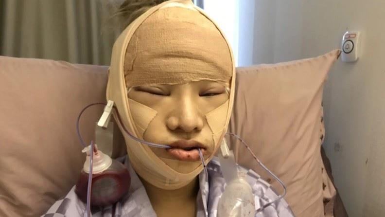 術後復原艱辛過程曝！小A辣一句鼻酸了