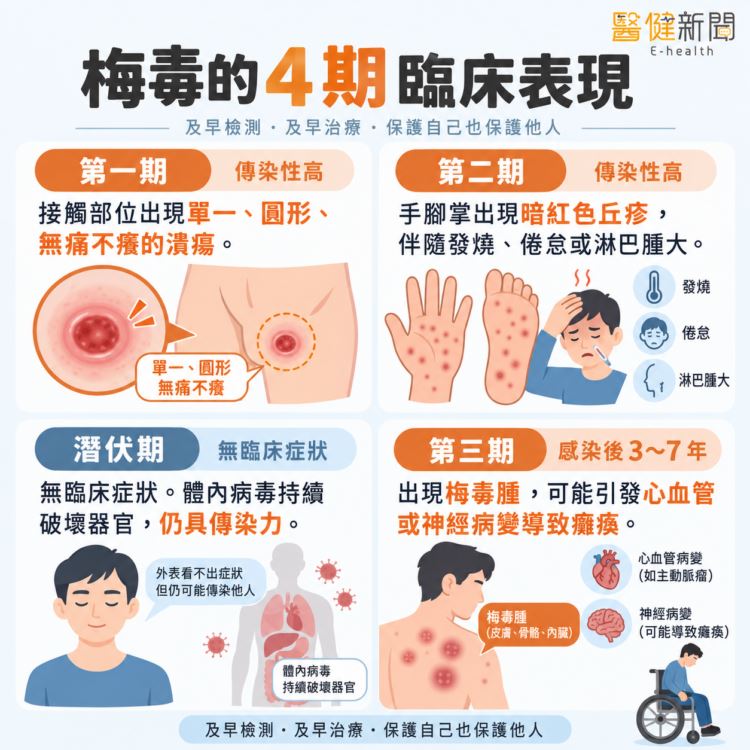 傷口自己好不代表痊癒!不可不知的梅毒4大臨床病程。(圖/醫健新聞網提供)