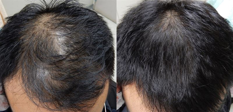 37歲鄭姓男子經過補充鋅6周後，頭髮竟全數長回來，從稀疏恢復到濃密。（圖／中港澄清醫院提供）