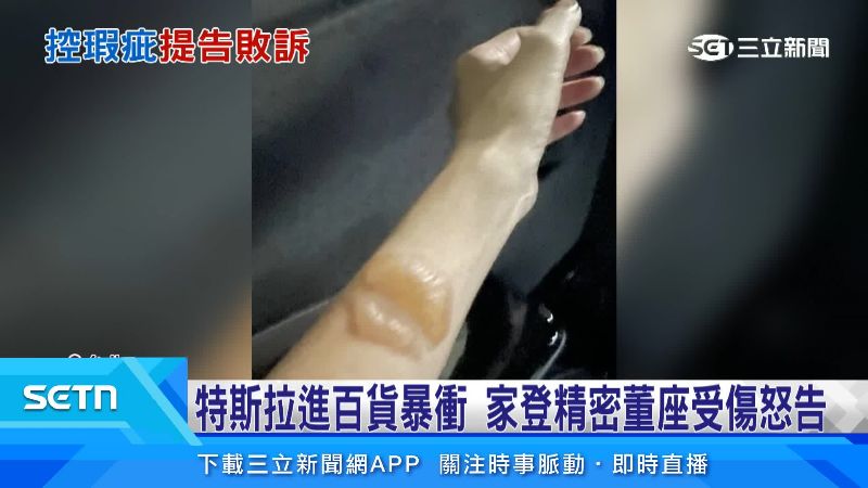 家登董娘車禍後手臂被燙出大水泡