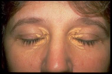 醫師表示,看似影響美觀的「黃色瘤」,其實是身體脂質代謝異常的「求救訊號」。(圖/取自振興醫院粉專)