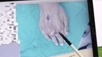 45歲男患高血壓、糖尿病！手背「腫巨石」