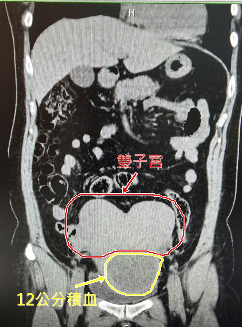50歲婦因具有雙子宮特殊的生理構造,導致大量經血長期累積在骨盆底部。(圖/林新醫院提供)
