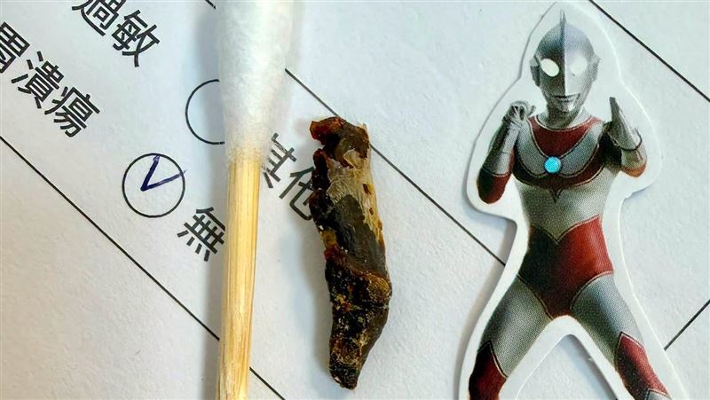 在兩名護理人員及媽媽抱緊處理下,順利夾出男童長達六年「又長又黑」的巨型耳垢。(圖/郭子龍授權提供)