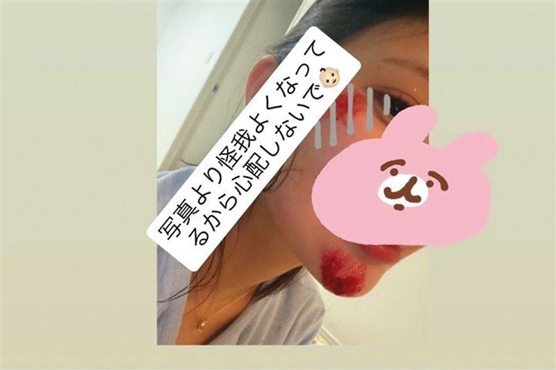 流出的對話截圖中,倉木華曾貼出自己的臉部傷勢,控訴事故後平良翔太避不處理。(圖/翻攝自倉木華IG)