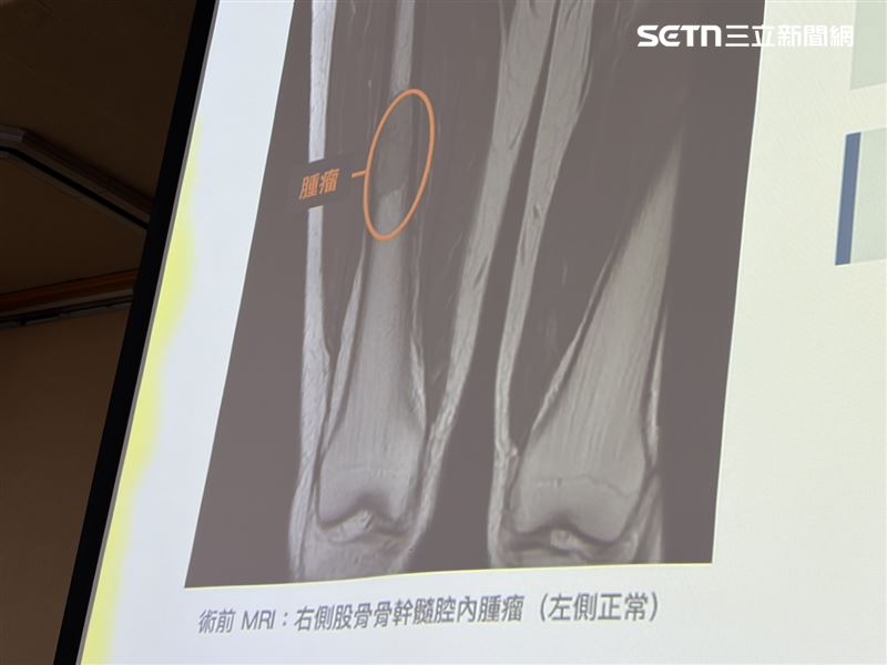 王小姐大腿痛忍2個月,就醫檢查竟骨癌3期,腫瘤大如拇指。(圖/記者簡浩正攝影)