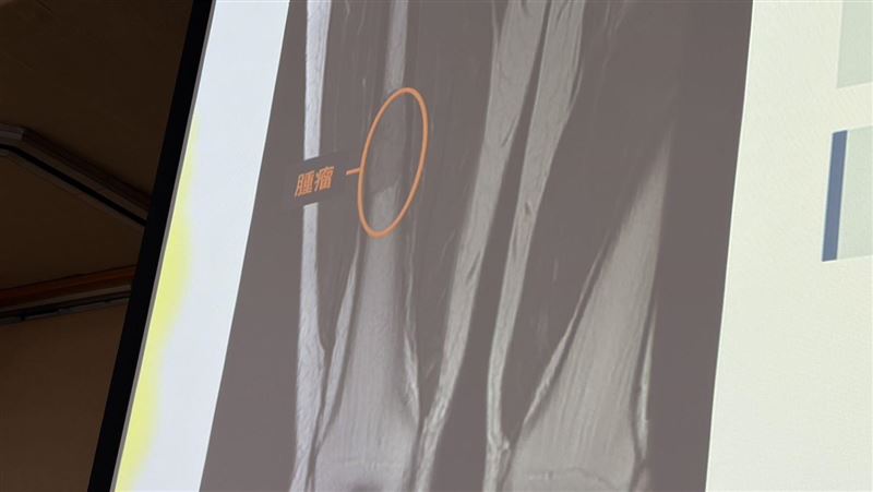 她「大腿痛」忍2個月竟骨癌 腫瘤大如拇指