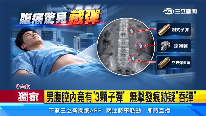 男子腹腔內竟有3顆子彈,分別為制式子彈、達姆彈,及1顆空包彈彈頭