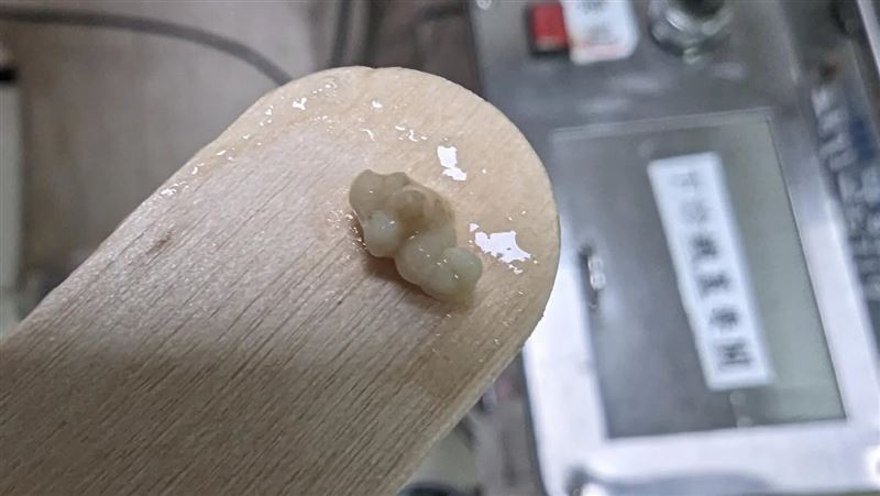 李晏廷表示,「扁桃腺結石」除了讓喉嚨有異物感及口臭外,部分患者也可能出現喉嚨反覆不適或發炎等症狀。(圖/翻攝自醫師李晏廷臉書)