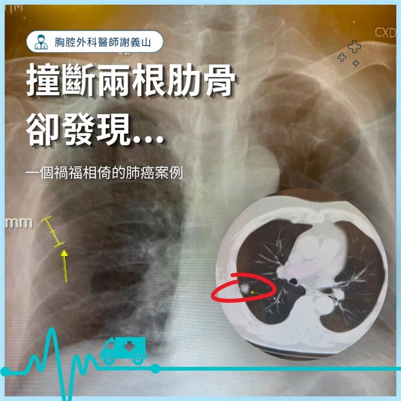 一名男子因撞斷肋骨就醫,卻意外發現罹患肺腺癌。(圖/醫師謝義山授權提供)
