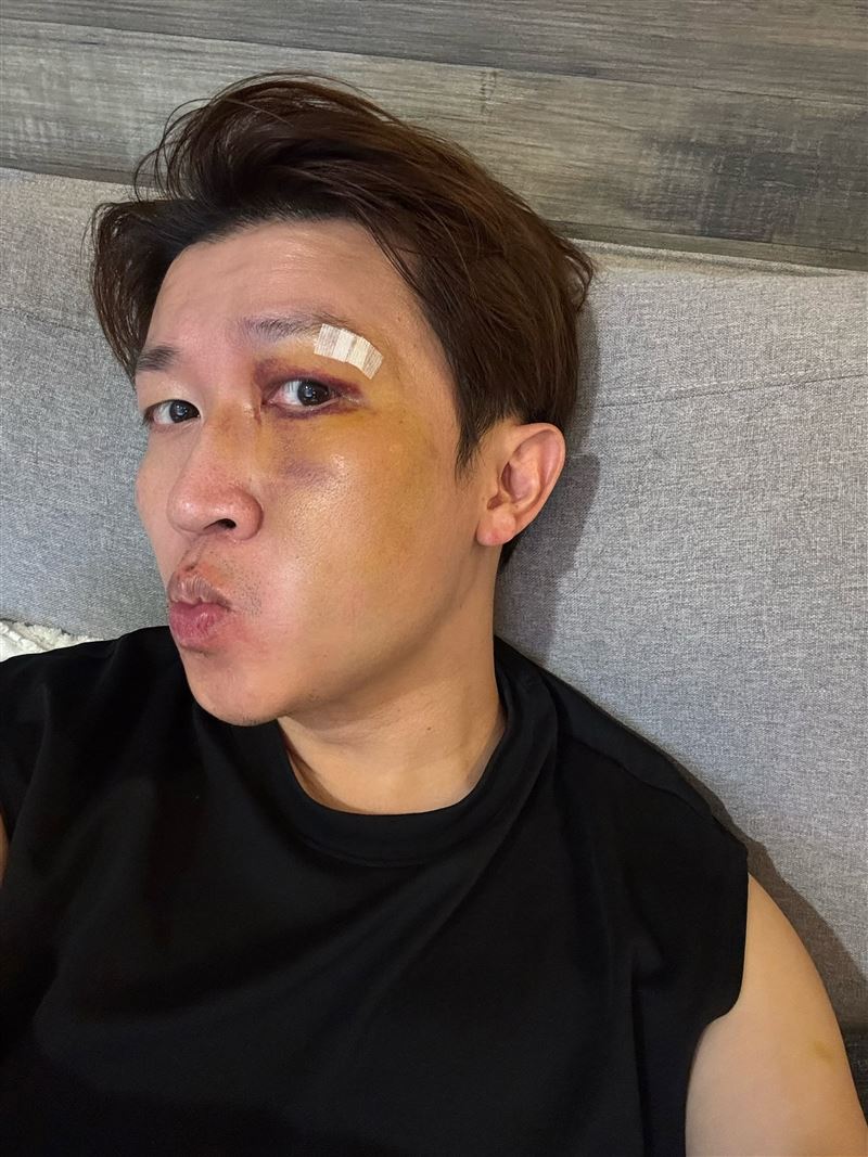 張立東在家跌倒腫成豬頭。（圖／翻攝自張立東臉書）
